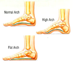 Cavus Foot: Abnormally High Arches
