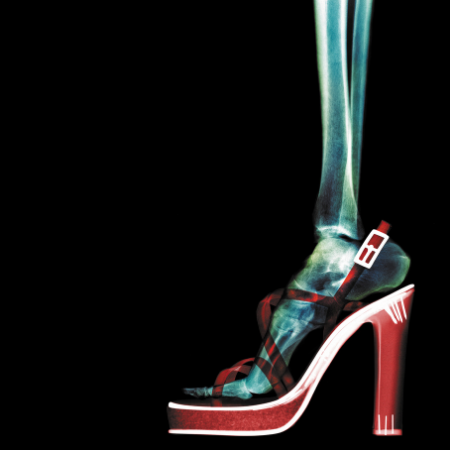 xray image of how high heels affect the foot