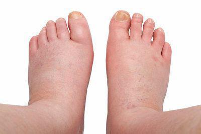 Tips to Ease Your Swelling Feet
