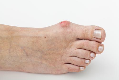 Home Care for Bunion Pain
