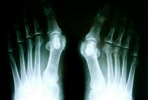 Understanding Deformities of the Foot