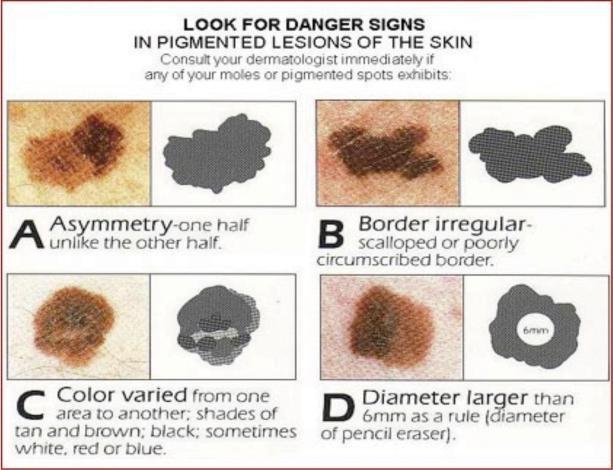 Skin Cancer and Your Feet