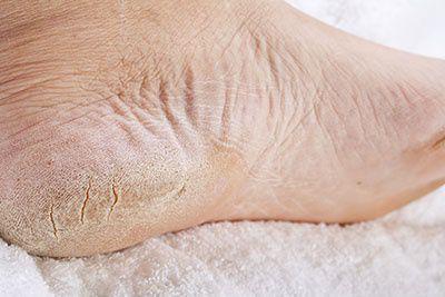 Diabetic Skin Care for Feet