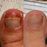 Fungal Skin and Nail Pack