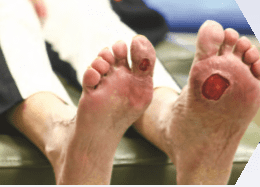 EpiFix Treatment for Diabetic Foot Ulcers