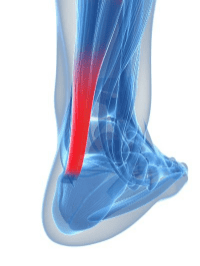 Achilles Problems: Trouble with Your Power Tendon