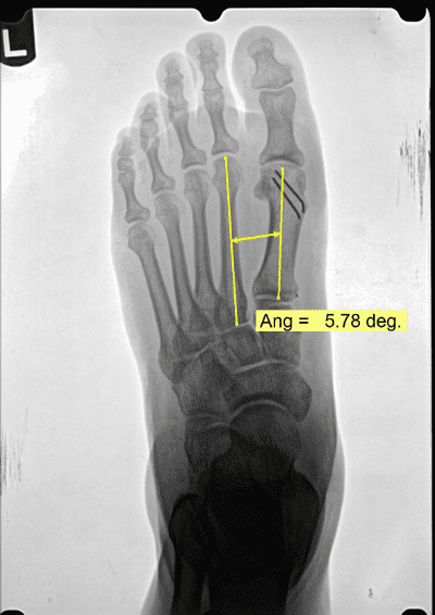 Moderate Bunion Deformity Surgery Results