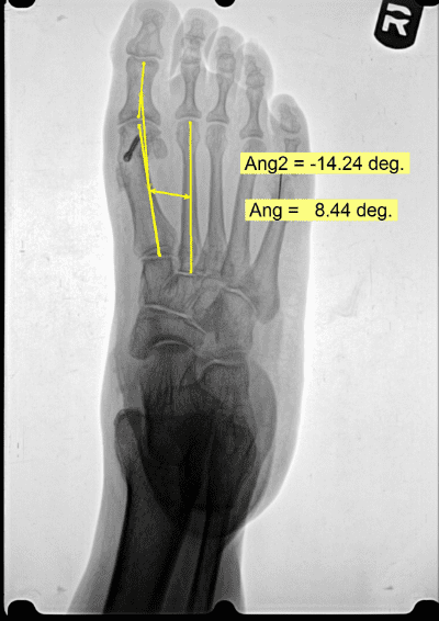 Bunion Surgery Results