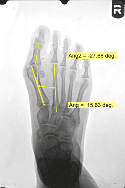 Results of Surgery for Severe Bunion