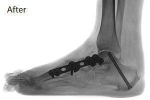 Successful Charcot Foot Surgery