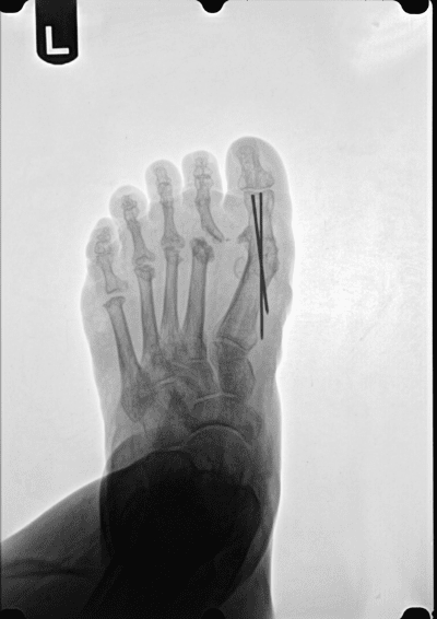 Forefoot Surgery Results
