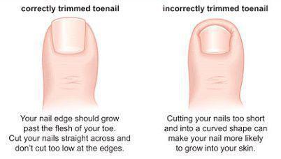 In-Grown Toenails in Pleasanton & Universal City, TX | Next Step Foot &  Ankle Clinic