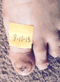 Case Results: Toenail Fungus Treatment Results