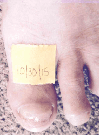 Case Results: Toenail Fungus Treatment Results