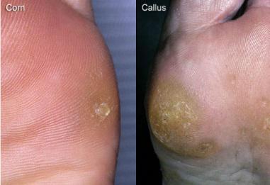 Corns and Calluses: Friction on Skin