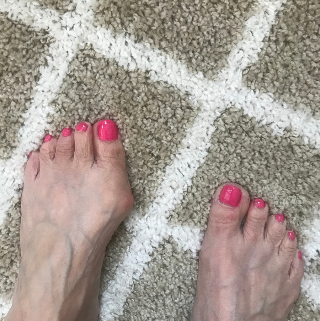 What to Know About Bunions