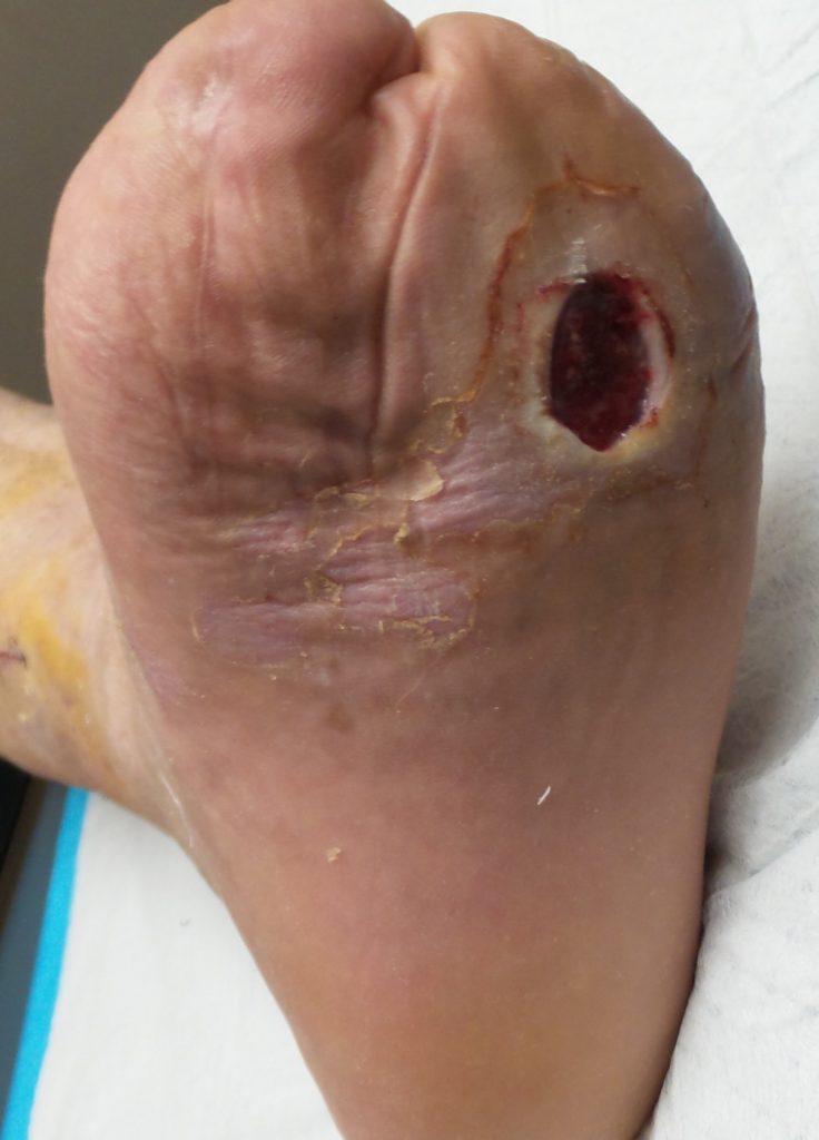 Image of a Diabetic Foot Ulcer