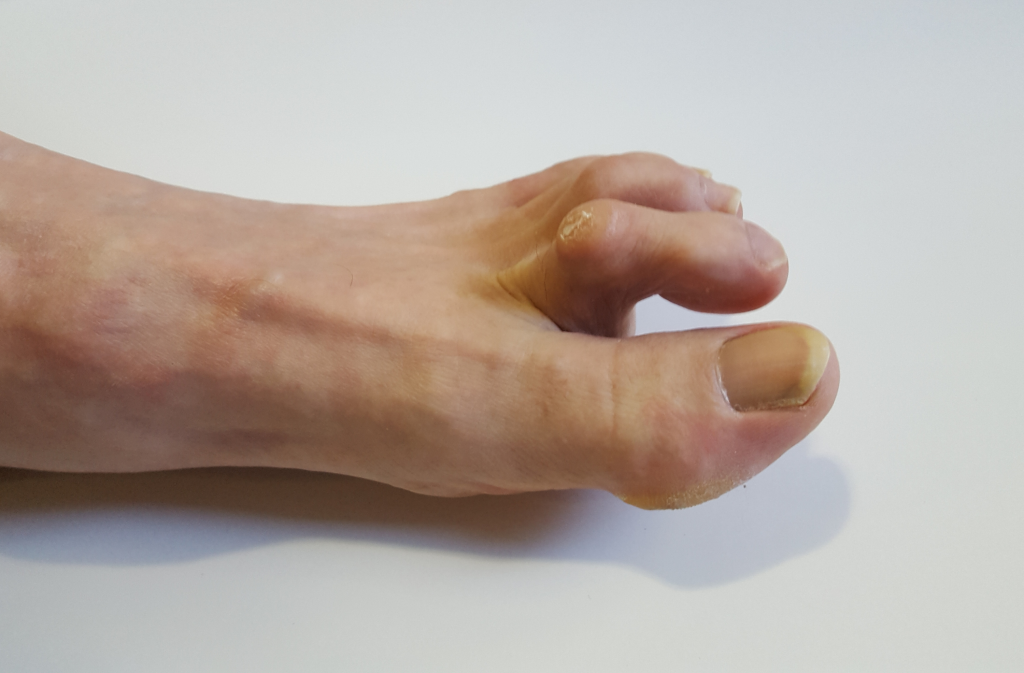 5 Things to Know About Hammertoes