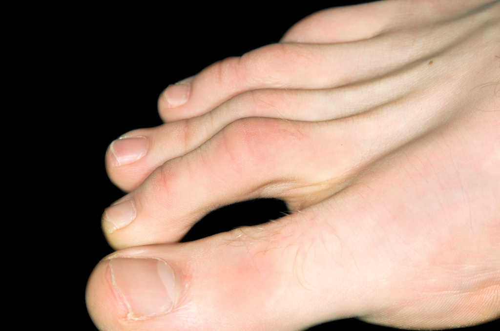 5 Things to Know About Hammertoes
