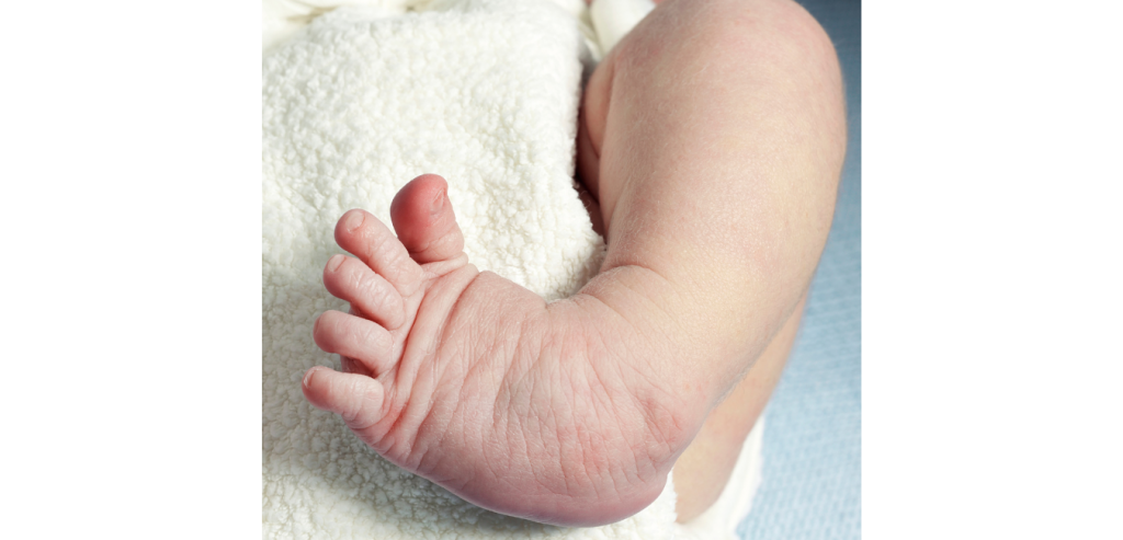 Clubfoot: Curved Baby Feet